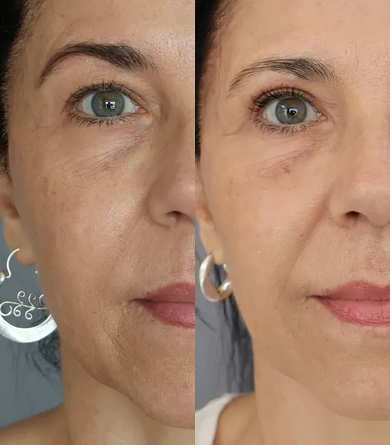 Blefaroplastia
