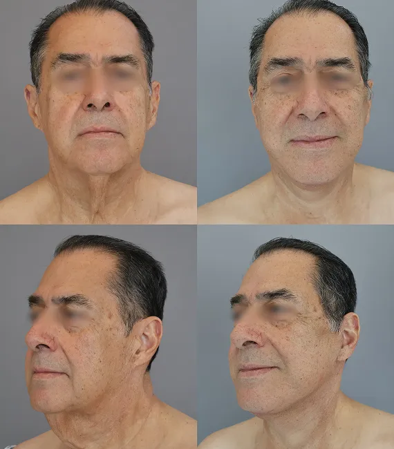 Lifting Facial