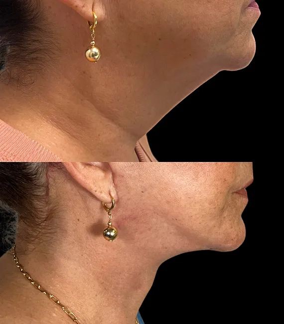 Lifting Facial