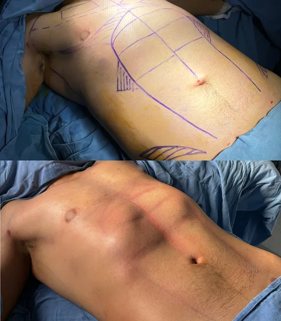 Lipoescultura