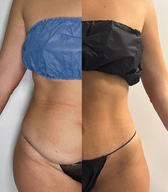 Lipoescultura