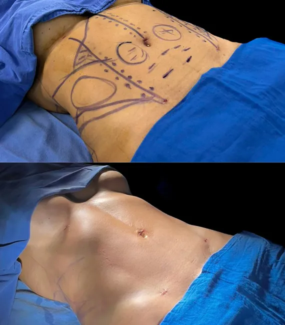 Lipoescultura