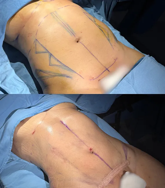 Lipoescultura