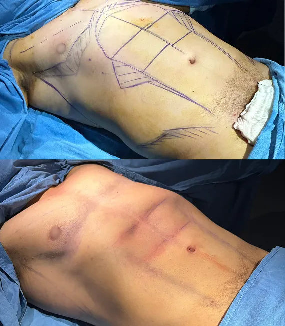 Lipoescultura