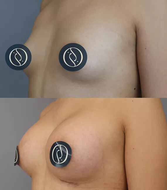 Mamoplastía